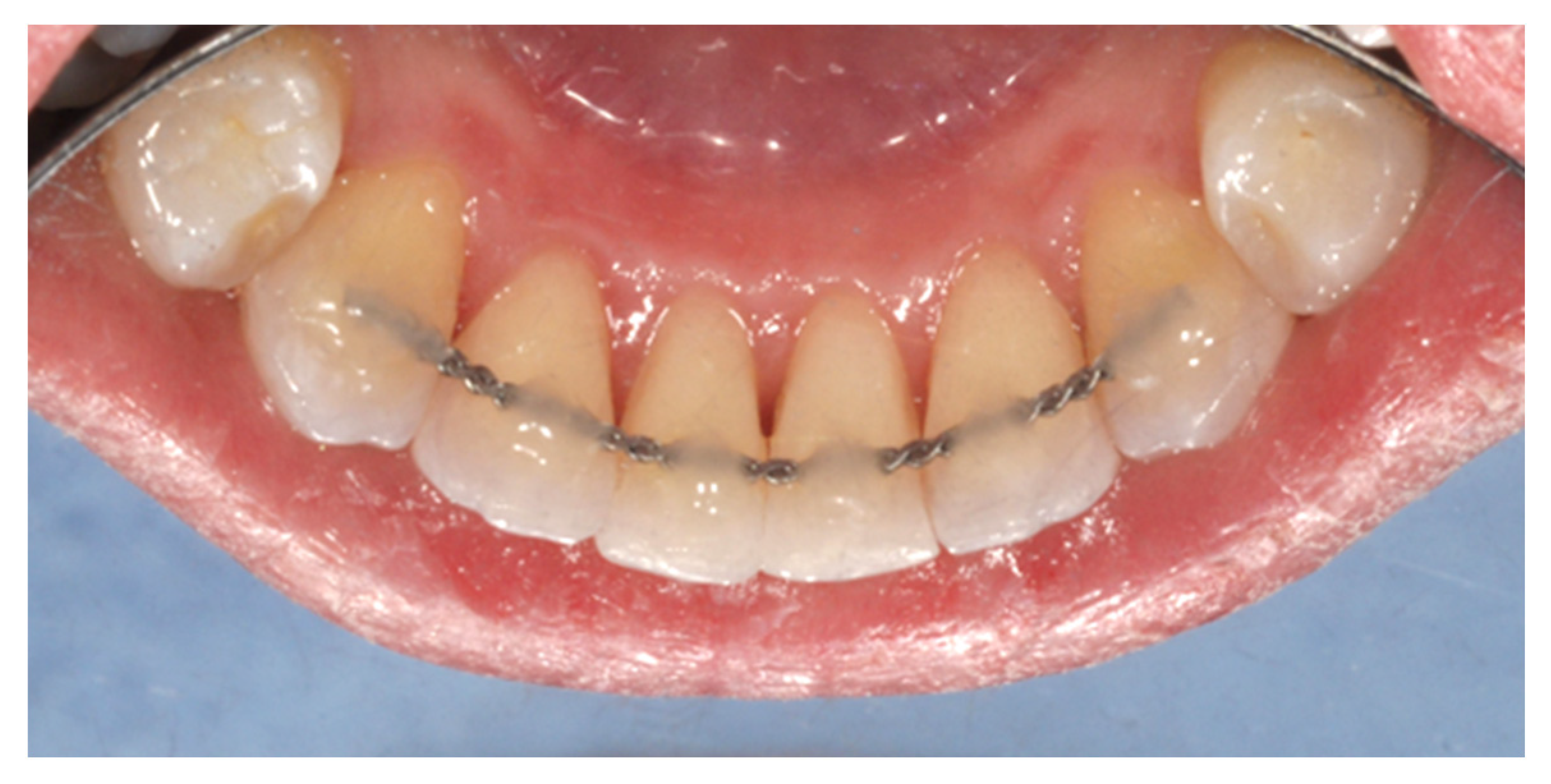 이중 유지장치 시스템
